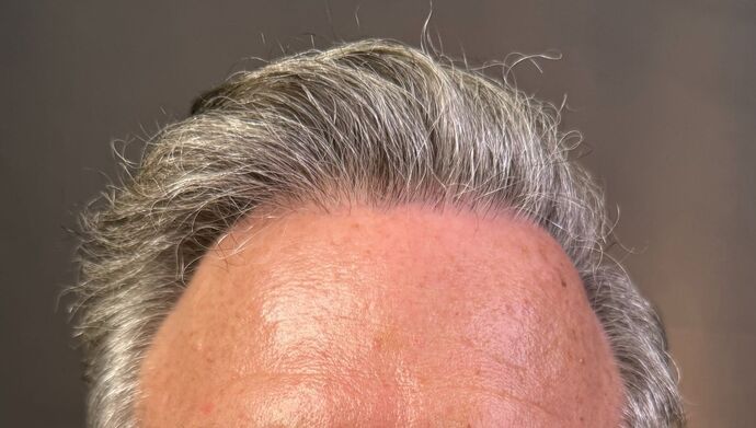 FUT Hair Restoration Case 51 - After