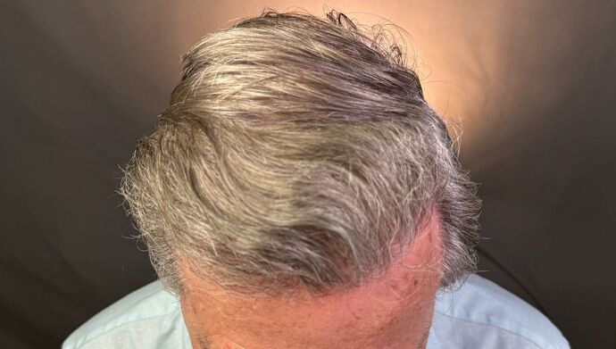 FUT Hair Restoration: Case 51 - After