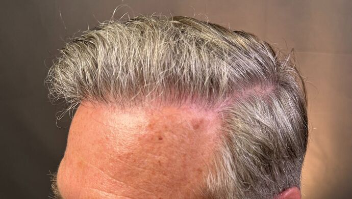 FUT Hair Restoration: Case 51 - After