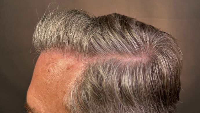 FUT Hair Restoration: Case 51 - After