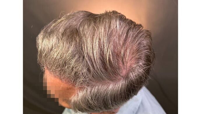 FUT Hair Restoration: Case 51 - After