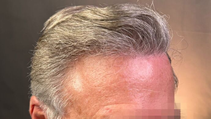 FUT Hair Restoration: Case 51 - After