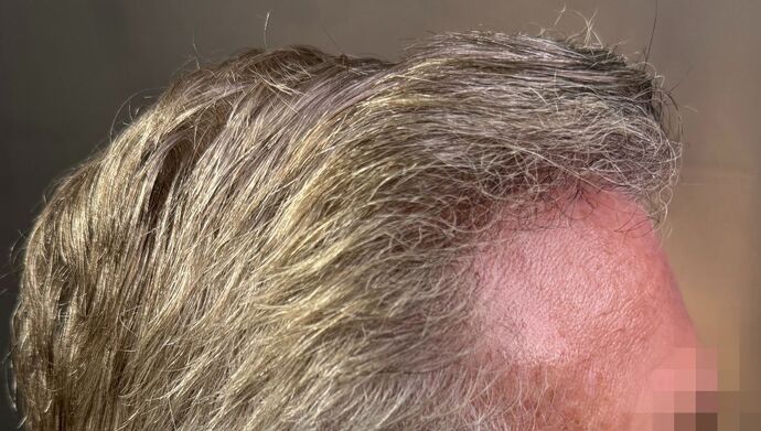 FUT Hair Restoration: Case 51 - After
