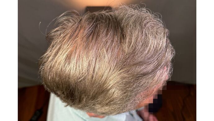 FUT Hair Restoration: Case 51 - After