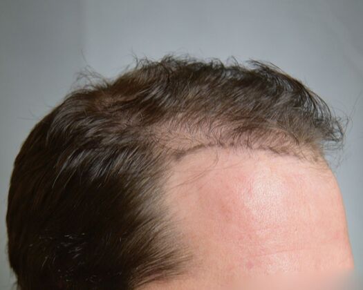 FUE Hair Restoration: Case 47 - Before