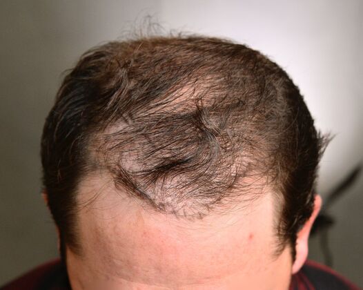 FUE Hair Restoration: Case 47 - Before