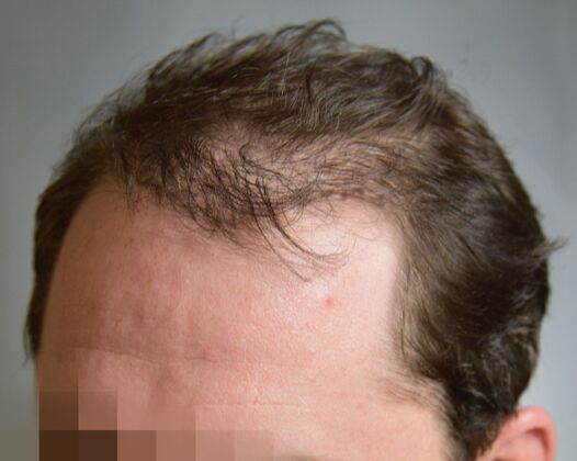 FUE Hair Restoration: Case 47 - Before