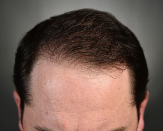 FUE Hair Restoration: Case 47 - After