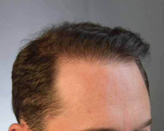 FUE Hair Restoration: Case 47 - After