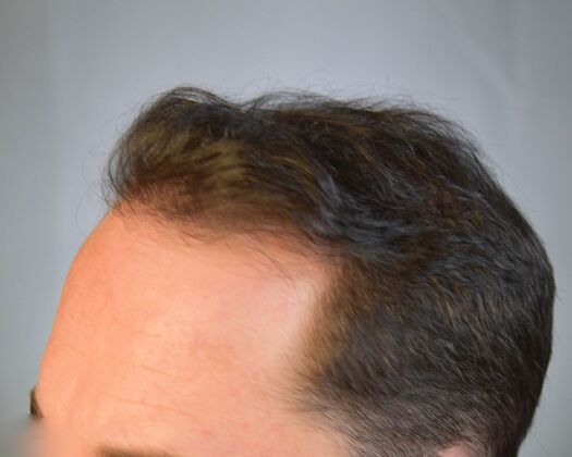 FUE Hair Restoration: Case 47 - After