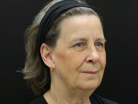 Face & Neck Lifts: Case 53 - Before