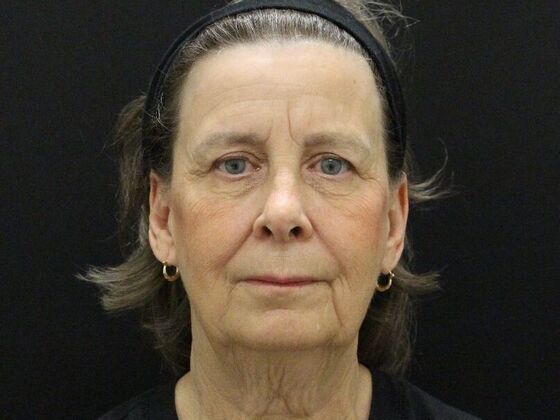 Face & Neck Lifts Case 53 - Before