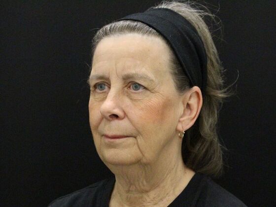 Face & Neck Lifts: Case 53 - Before