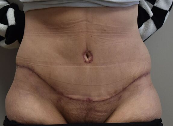 Tummy Tuck (Abdominoplasty): Case 526 - After