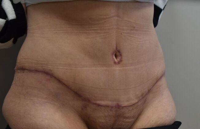 Tummy Tuck (Abdominoplasty): Case 526 - After