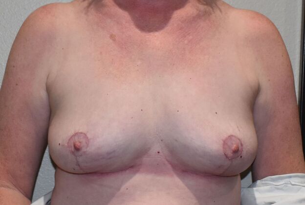Breast Implant Removal: Case 52 - After