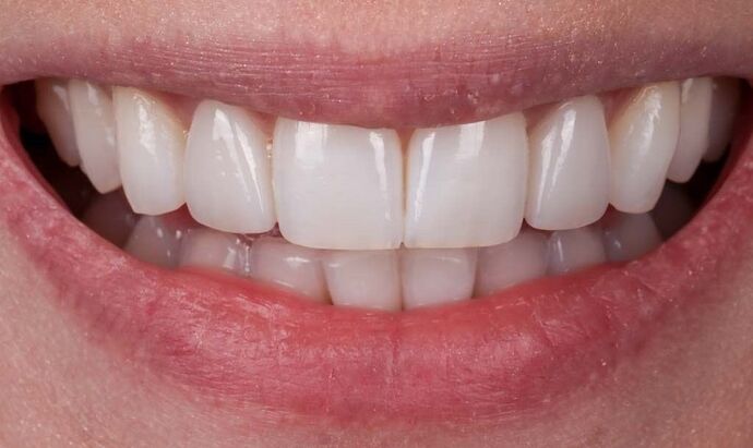 Smile Makeover & Veneers: Betty - After