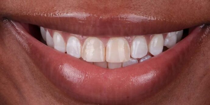Smile Makeover & Veneers: Ella - Before