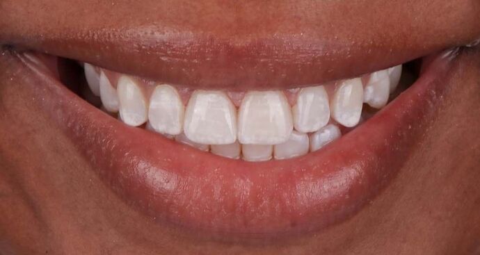 Smile Makeover & Veneers: Ella - After