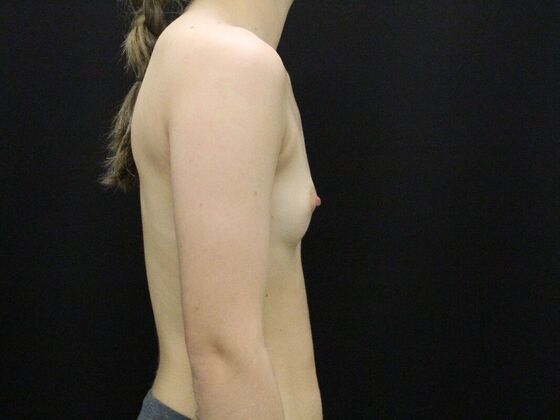 Breast Augmentation: Case 44 - Before