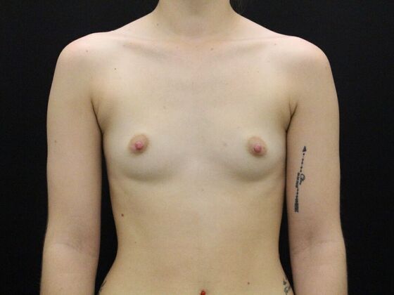 Breast Augmentation Case 44 - Before