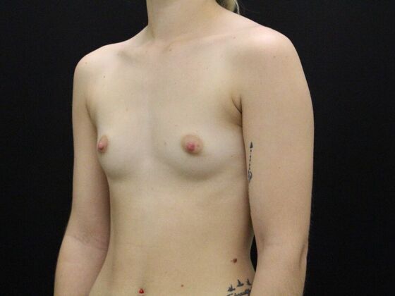 Breast Augmentation: Case 44 - Before