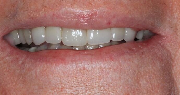 Porcelain Crowns Case 19 - Before