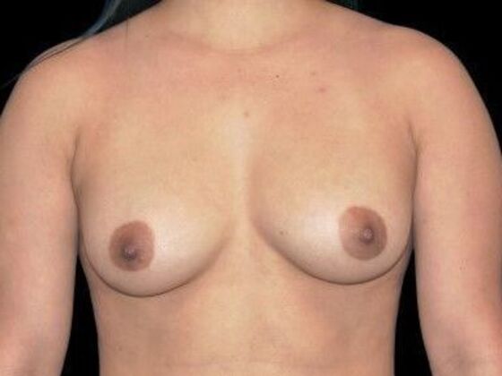 Breast Augmentation Case 5 - Before
