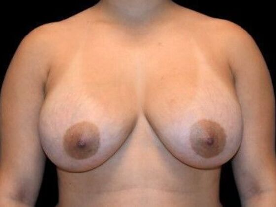 Breast Augmentation Case 5 - After
