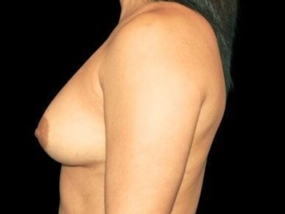 Breast Augmentation: Case 5 - Before