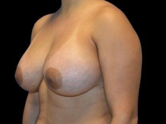 Breast Augmentation: Case 5 - After