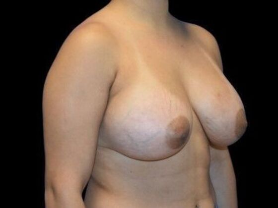 Breast Augmentation: Case 5 - After