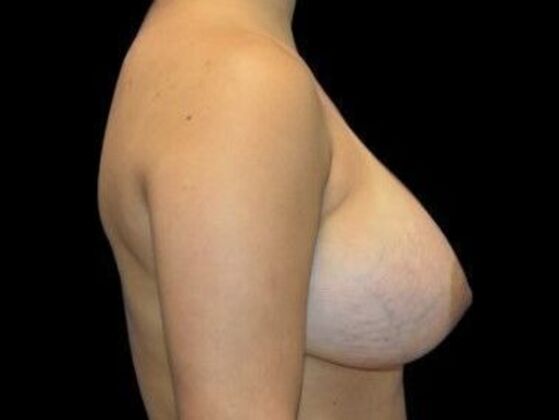 Breast Augmentation: Case 5 - After