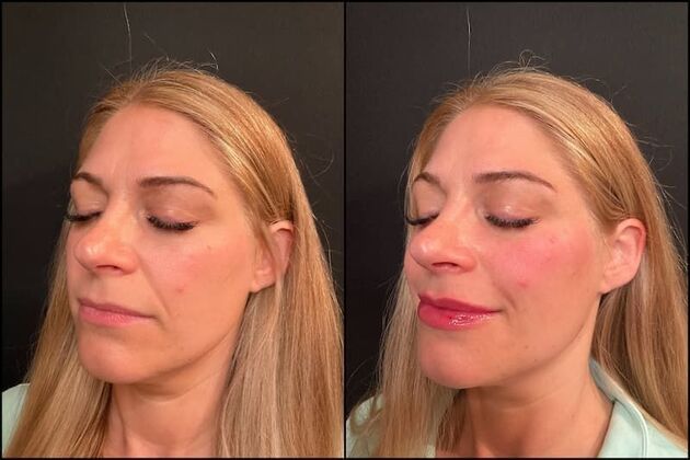 Fillers: Case 2 - Before & After