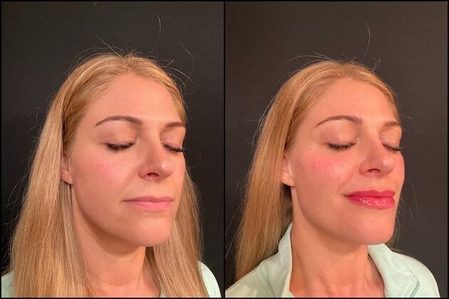 Fillers: Case 2 - Before & After