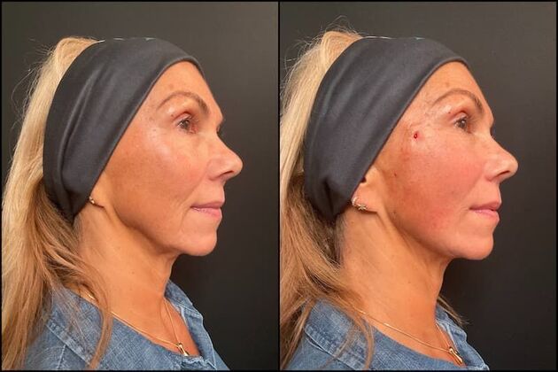 PDO Threads  Case 2- Non Surgical Face Lift 