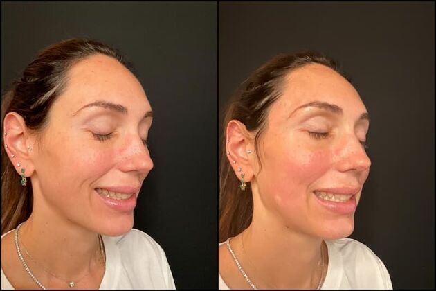 Collagen Bio-Stimulators Cases