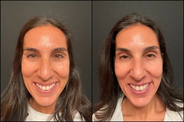 Daxxify (Botox alternative)  Case 10