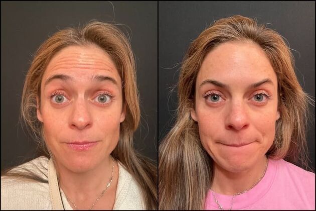 Daxxify (Botox alternative) : Case 2 - Before & After