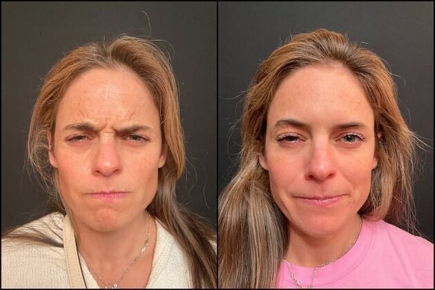 Daxxify (Botox alternative)  Case 2