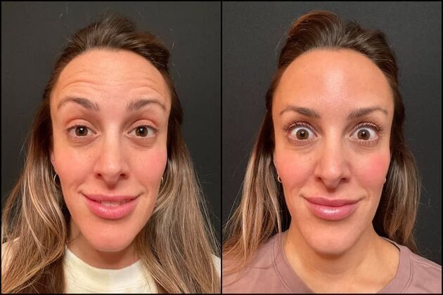 Daxxify (Botox alternative)  Case 3