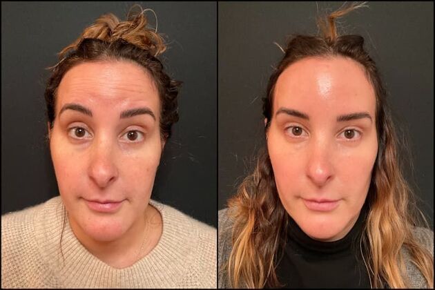 Daxxify (Botox alternative) : Case 4 - Before & After