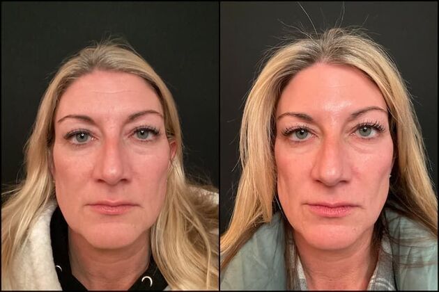 Daxxify (Botox alternative)  Case 5