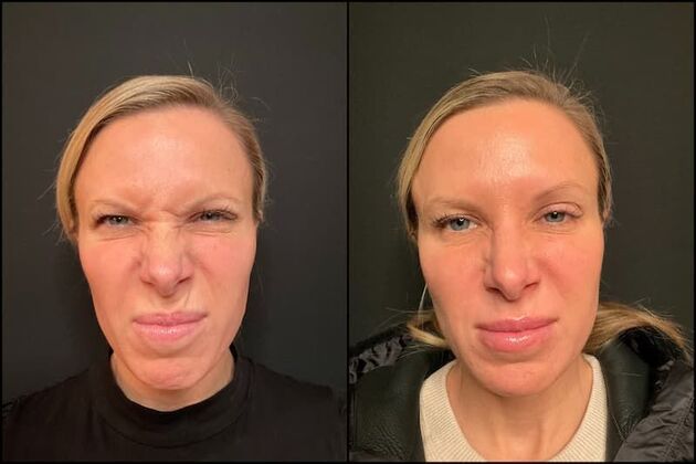 Daxxify (Botox alternative)  Case 6