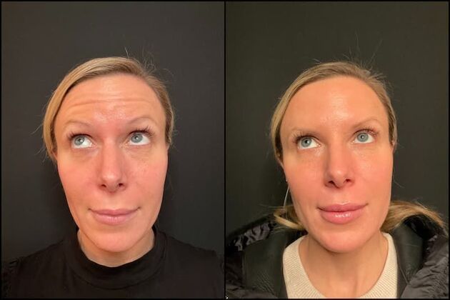 Daxxify (Botox alternative) : Case 6 - Before & After