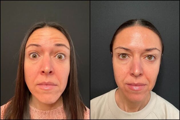 Daxxify (Botox alternative) : Case 7 - Before & After