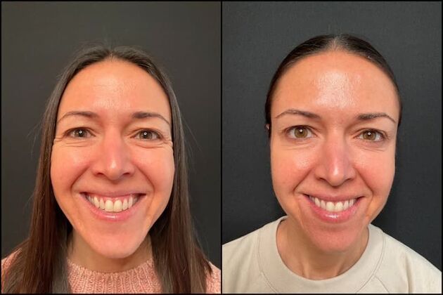 Daxxify (Botox alternative) : Case 7 - Before & After