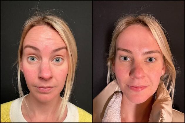 Daxxify (Botox alternative)  Case 8