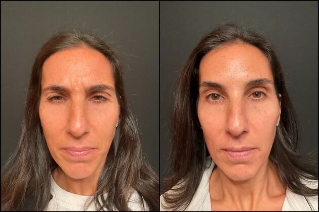 Daxxify (Botox alternative)  Case 9