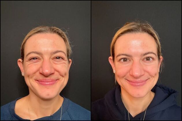 Daxxify (Botox alternative) Cases